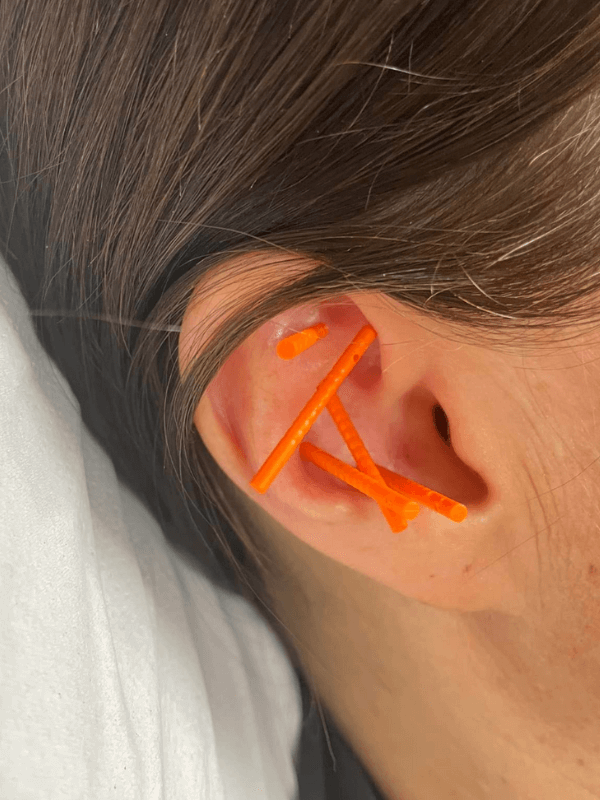 NADA ear acupuncture needles placed in the ear during a calming auricular acupuncture session in Middlesbrough
