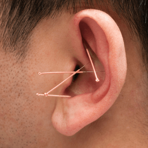 "Male patient experiencing a relaxing clinical acupuncture session for chronic pain relief at Deanna Thomas Acupuncture Middlesbrough, featuring ear acupuncture for nervous system regulation."